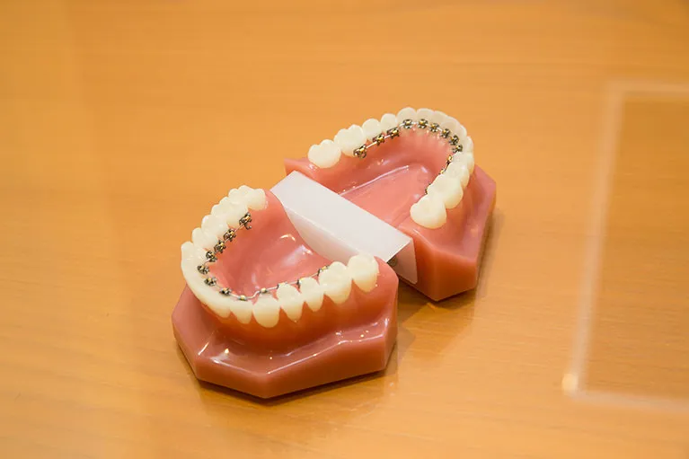 見えない舌側矯正（フルリンガル）