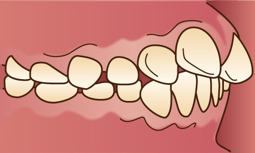 デコボコの歯並び・八重歯